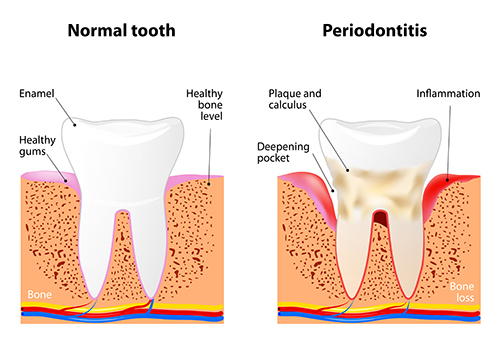 Gum disease treatment with Crown Hill Smiles in Loyal Heights Seattle.